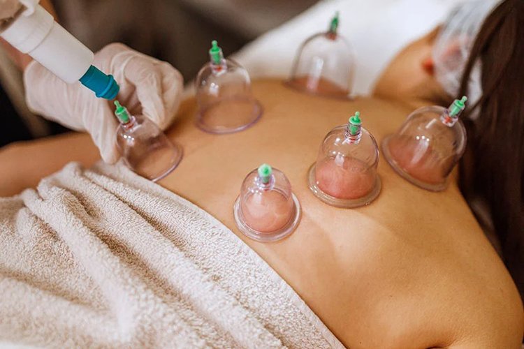 Benefits of Cupping Therapy