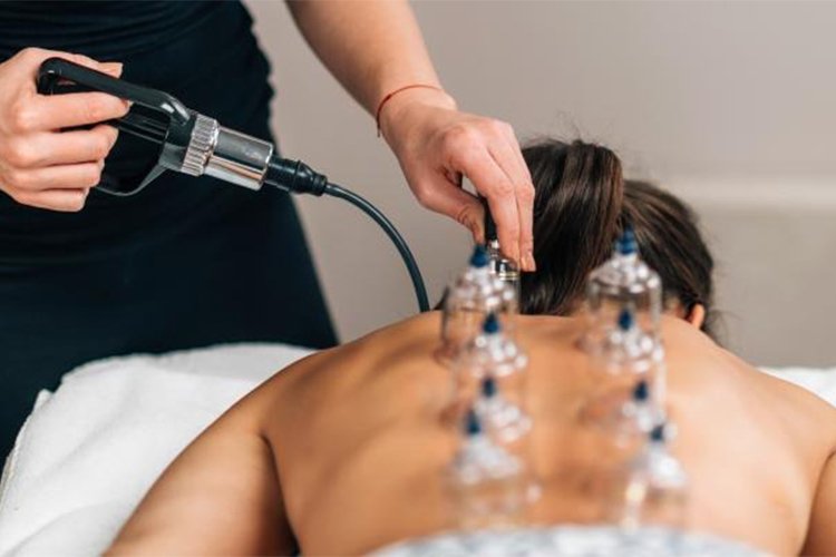 Benefits of Cupping Therapy