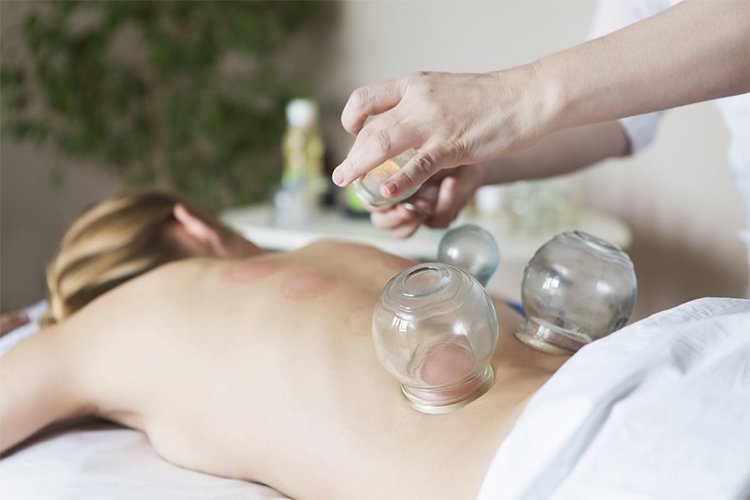 Benefits of Cupping Therapy