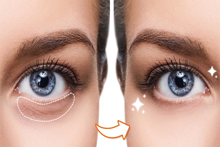 How to get Rid of Dark Circles Under Eyes