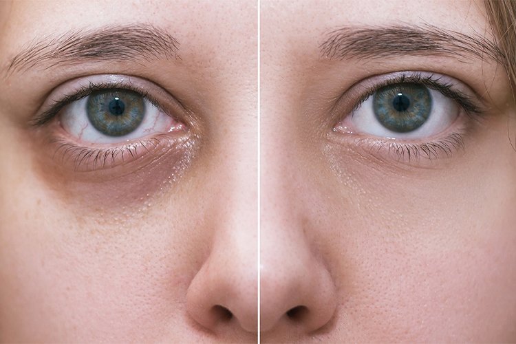 How to get Rid of Dark Circles Under Eyes