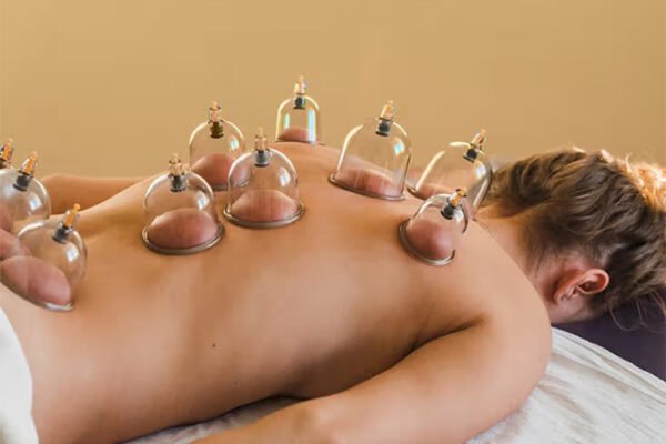 Benefits of Cupping Therapy