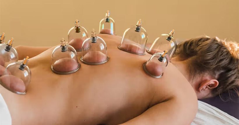 Benefits of Cupping Therapy